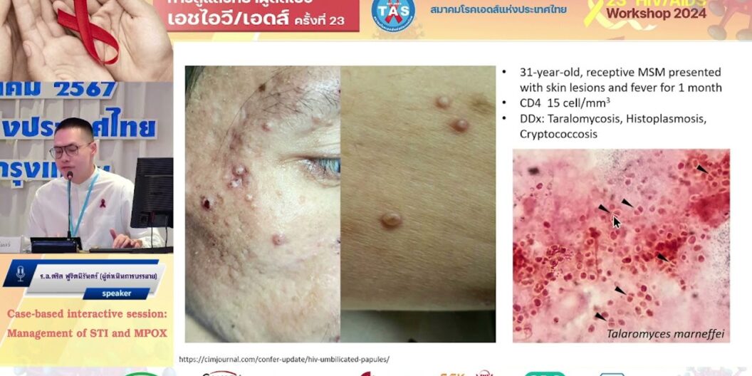 Management of STI and MPOX