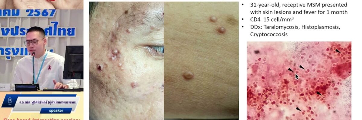 Management of STI and MPOX