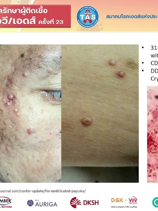 Management of STI and MPOX