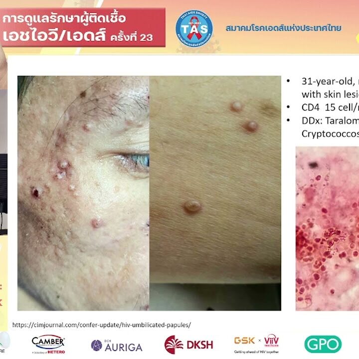 Management of STI and MPOX