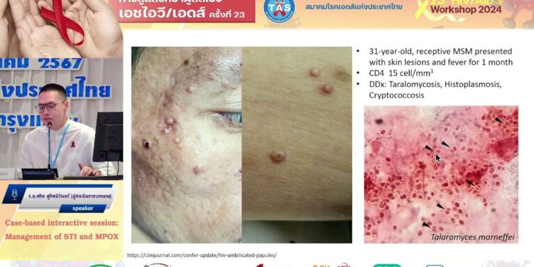 Management of STI and MPOX