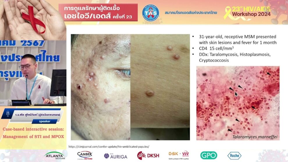 Management of STI and MPOX