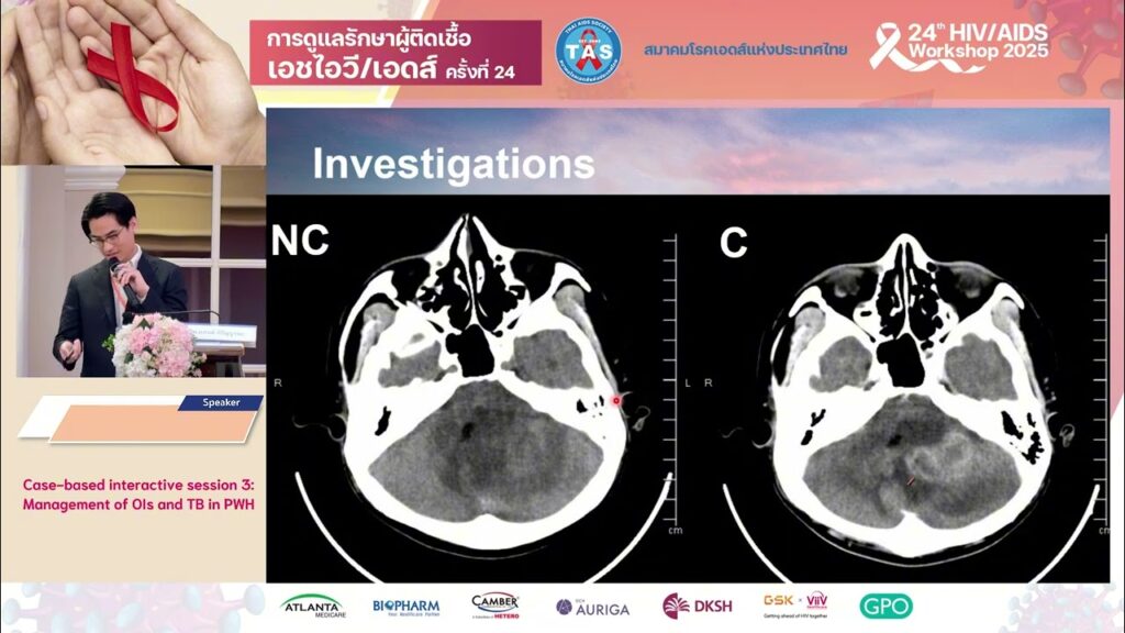 Case-based interactive session 3: Management of OIs and TB in PWH
