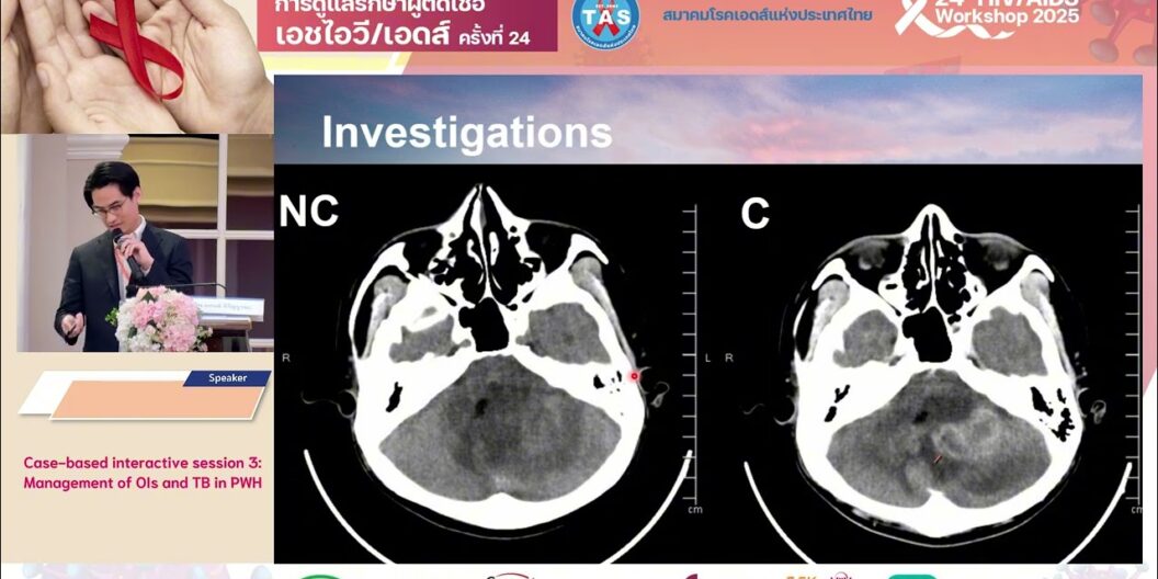 Management of OIs and TB in PWH