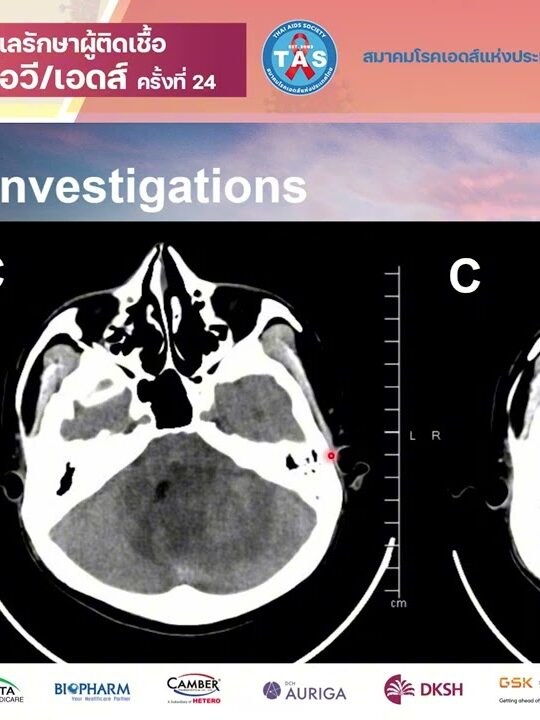 Management of OIs and TB in PWH