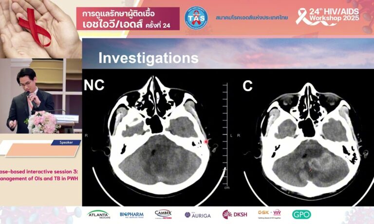 Management of OIs and TB in PWH